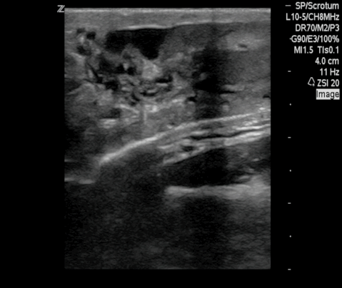  Bilateral small hydroceles and normal appearing testicles. 