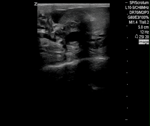  Bilateral small hydroceles and normal appearing testicles. 