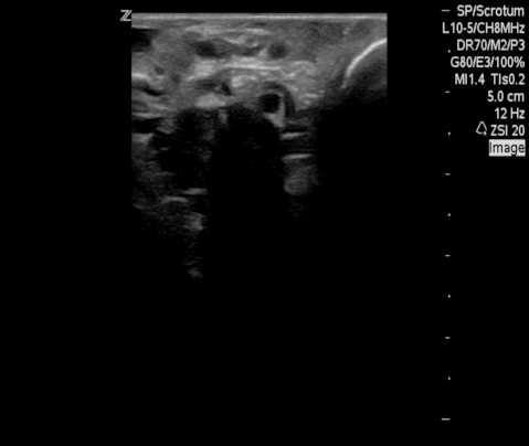  Bilateral dilated lymphatics. 