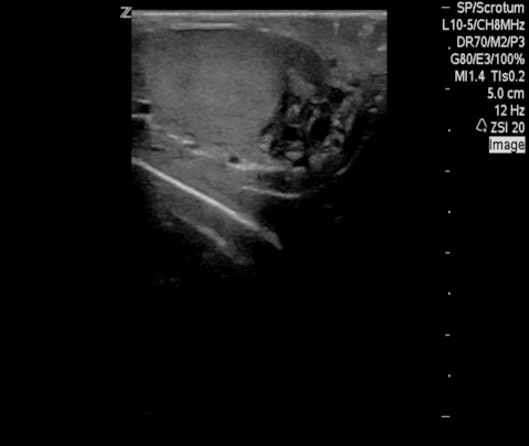  BBilateral dilated lymphatics 