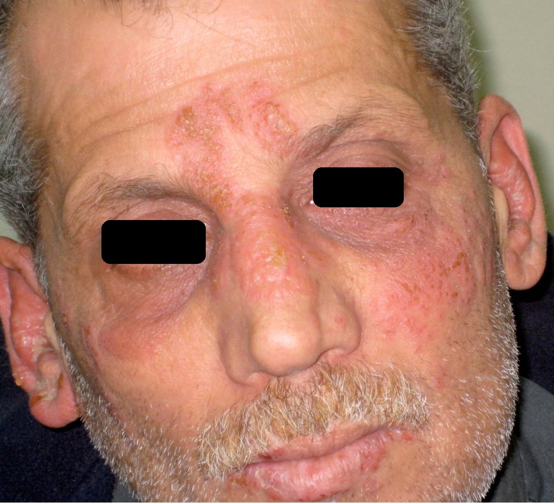 herpes on cheek of face