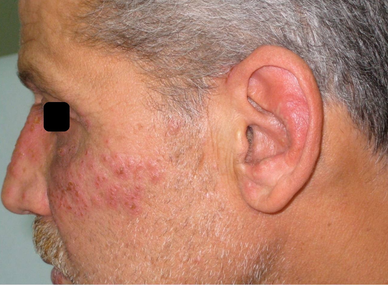 Disseminated Primary Hsv 2 Infection Of The Face