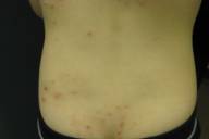 Treatment of molluscum contagiosum a brief review and discussion of a
