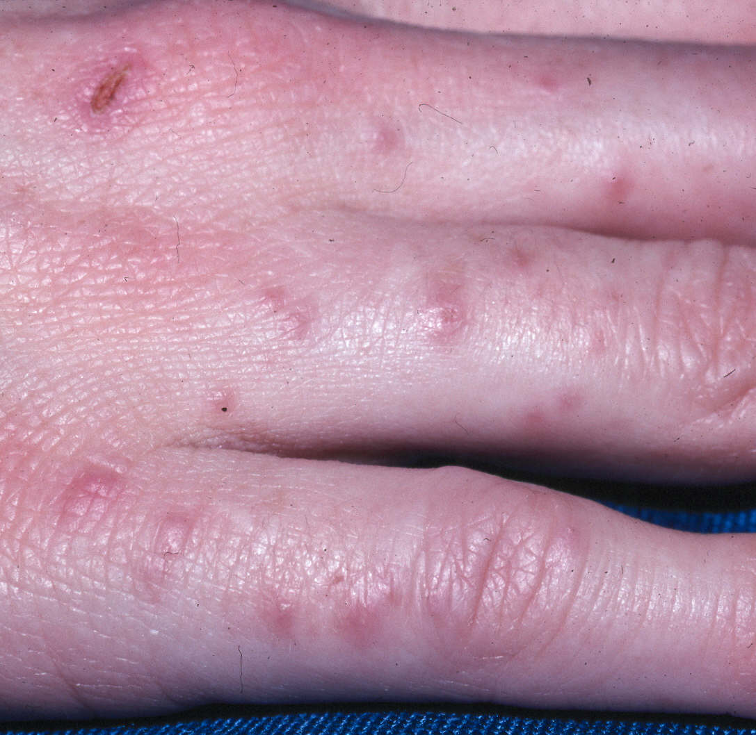 Lista 98+ Foto Fotos De Dermatitis En Las Manos El último