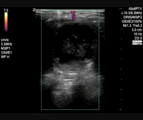  The umbilical hernia site utilizing power doppler. 