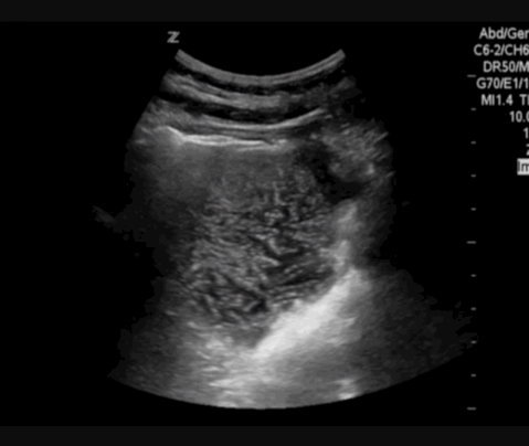  Dilated fluid filled small bowel. 