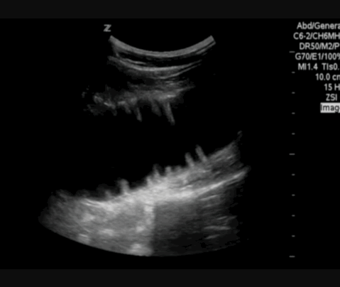  Dilated fluid filled small bowel. 