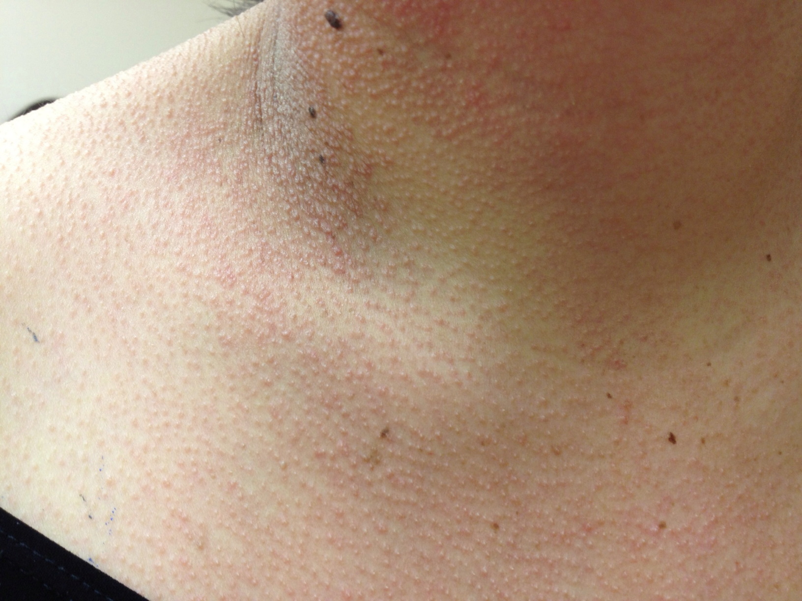 A Case Of Vemurafenib Induced Keratosis Pilaris Like Eruption