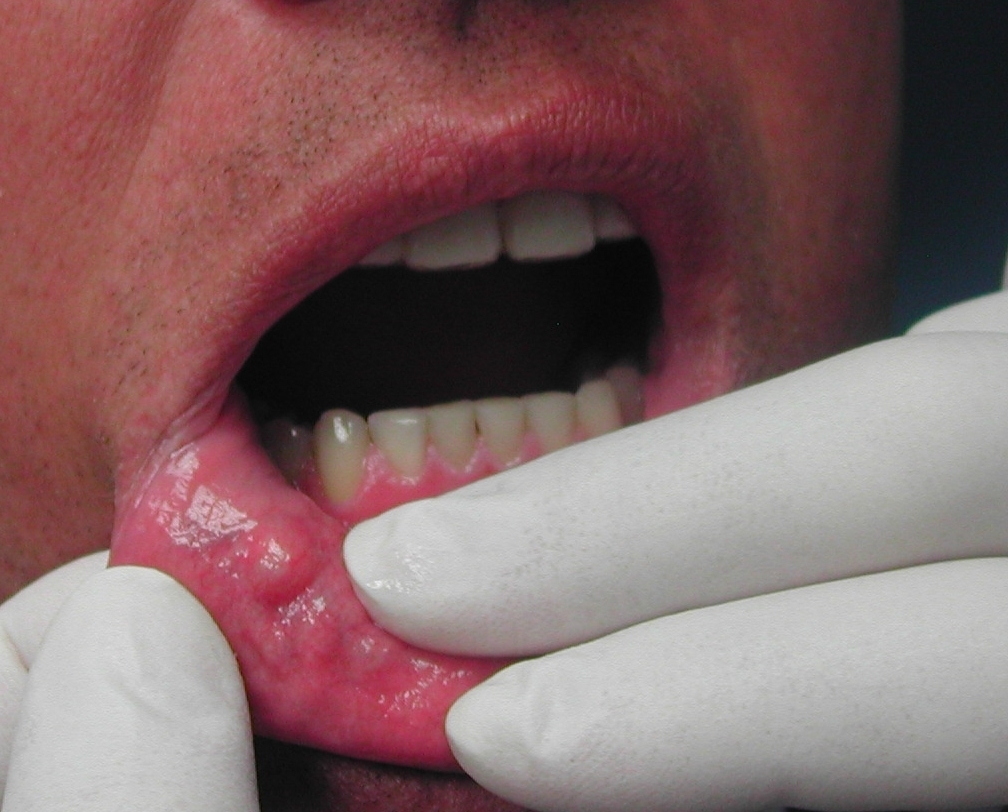 Mucoceles Not Oral Cysticercosis And Minor Salivary Gland