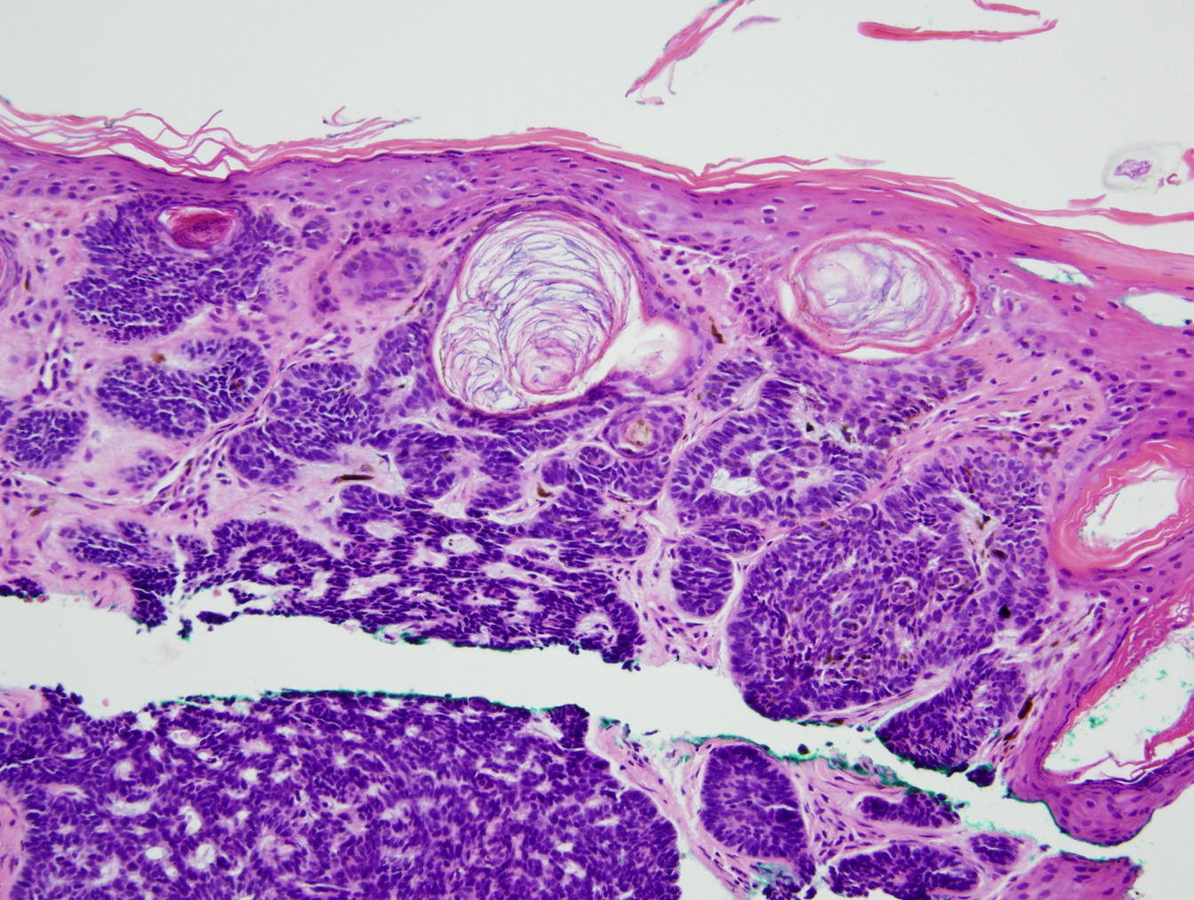 nevoid basal cell carcinoma syndrome histology