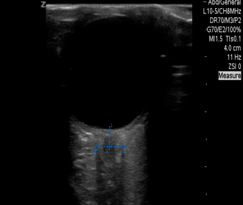  The patients Optic Nerve Sheath Diameter 