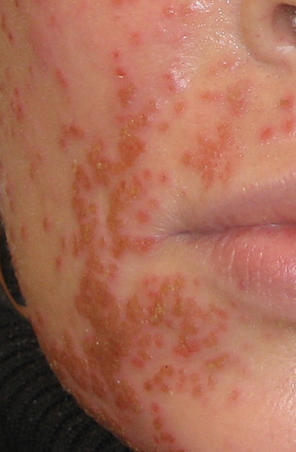 Kaposi Varicelliform Eruption Eczema Herpeticum