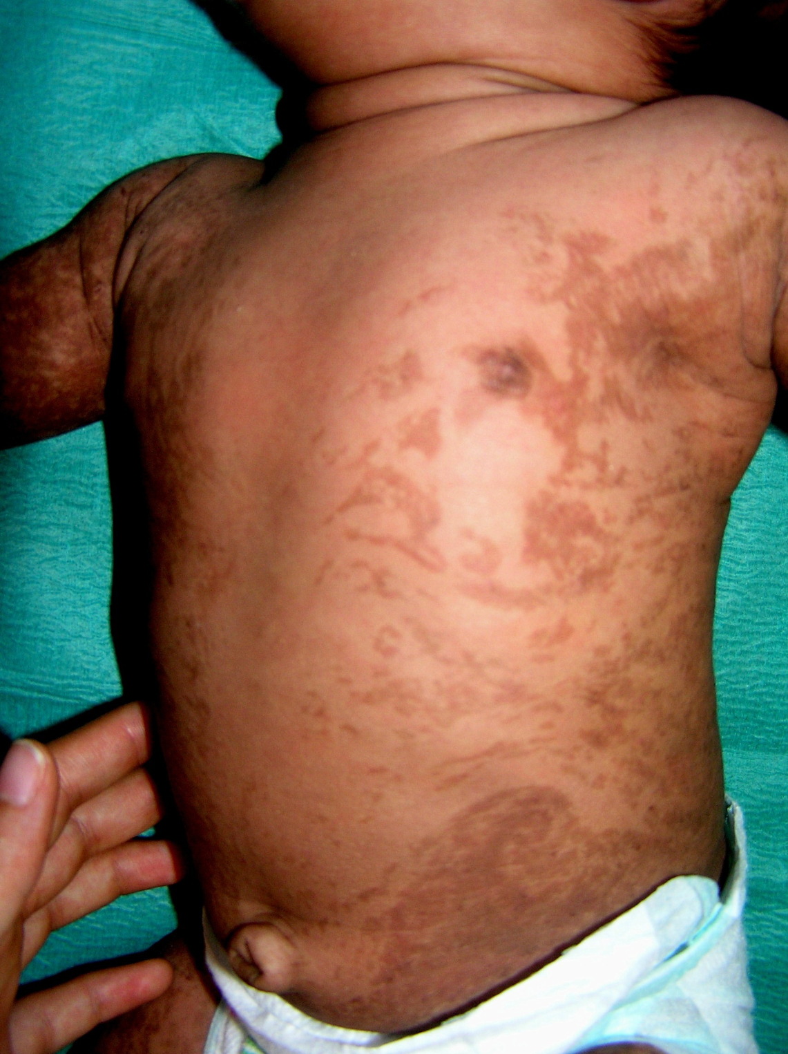 Incontinentia Pigmenti Axillaire QRMM