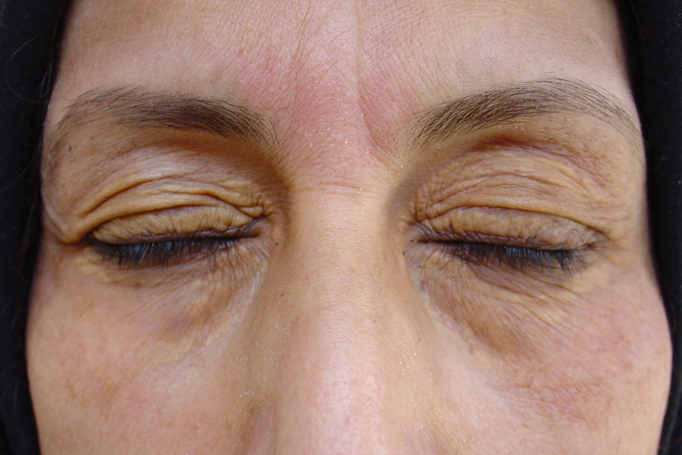 Koebner Phenomenon In Xanthelasma After Treatment With Trichloroacetic Acid