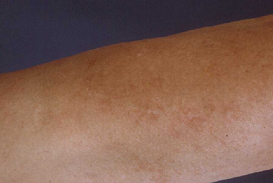 Telangiectasia Macularis Eruptiva Perstans Telangiectasia Macularis Eruptiva Perstans