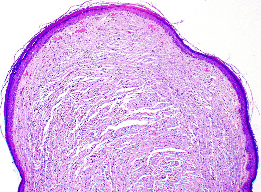 Palisaded Encapsulated Neuroma Pen An Often Misdiagnosed Neural Tumor